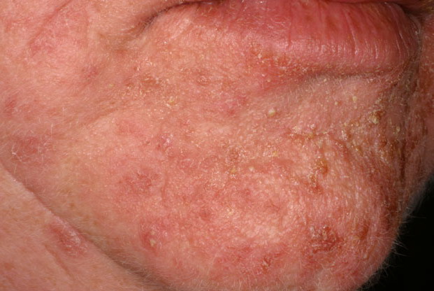 Bullous impetigo - Wikipedia