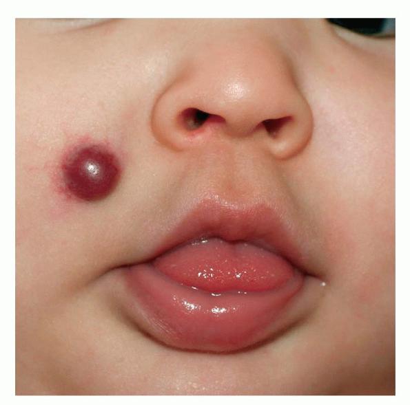 Hemangioma of Infancy (HI) Picture Image on MedicineNet.com