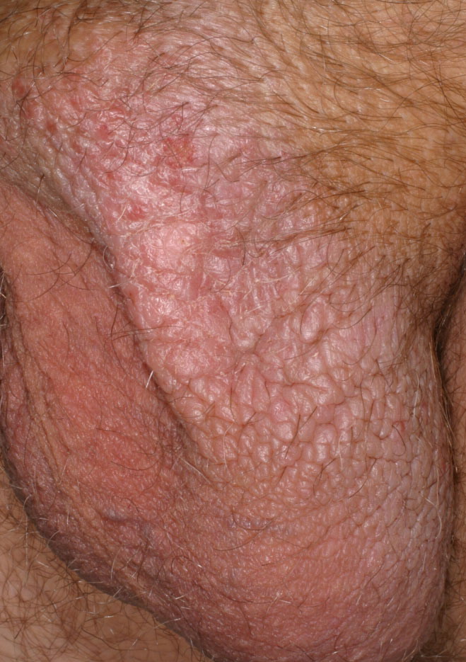Neurodermatitis (Lichen Simplex Chronicus) - Mayo Clinic