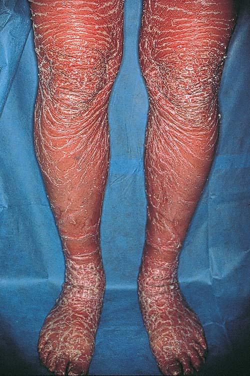lamellar ichthyosis1