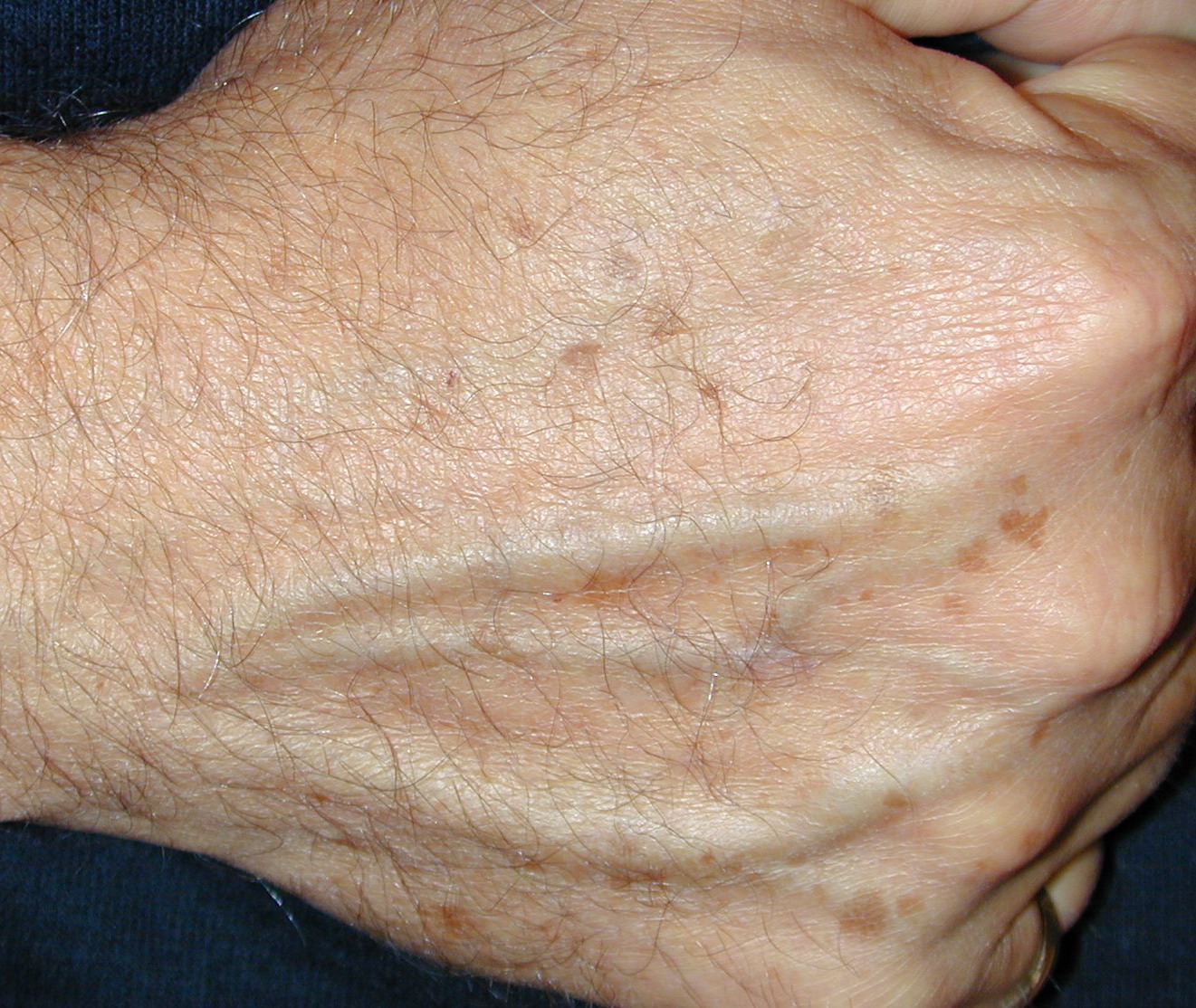 lentigines