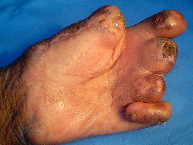 leprosy pictures