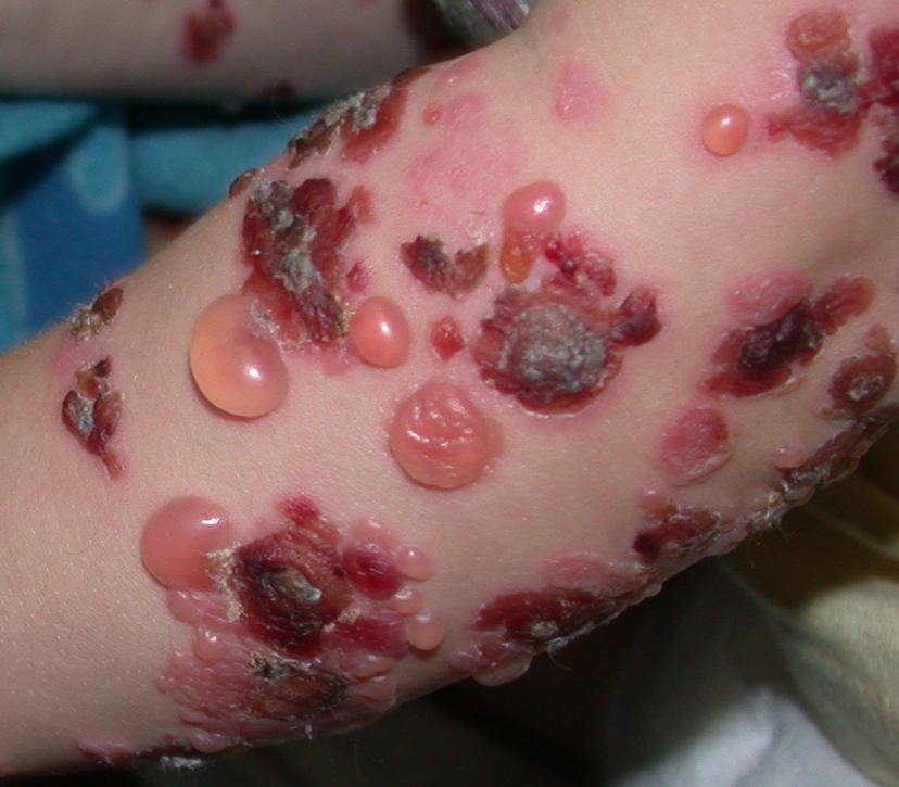 Lineaire IgA Dermatose (Chronic bullous disease of childhood)