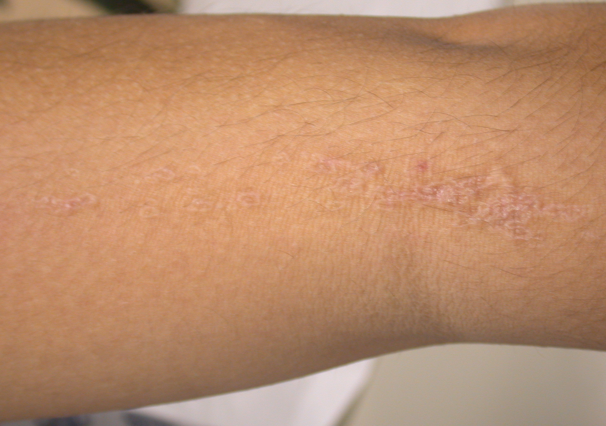 Porokeratosis Treatment