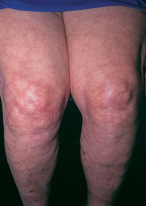 Livedo reticularis: A review of the literature