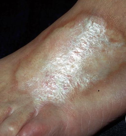 localized scleroderma