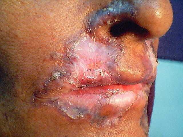 lupus vulgaris #10