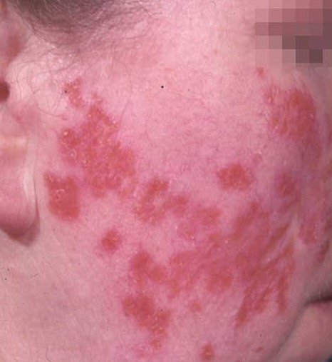 Lupus vulgaris, huidtuberculose | Mens en Gezondheid: Ziekten