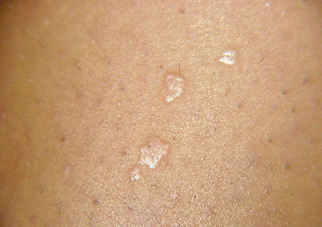 pictures of flat warts