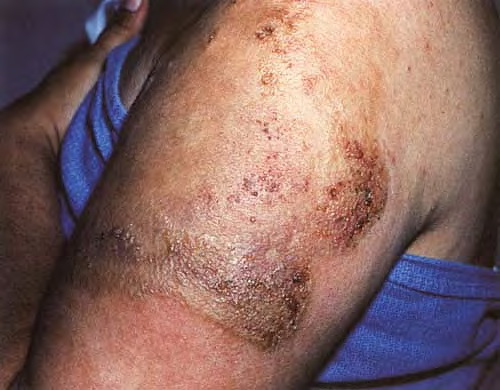 Angular Cellulitis