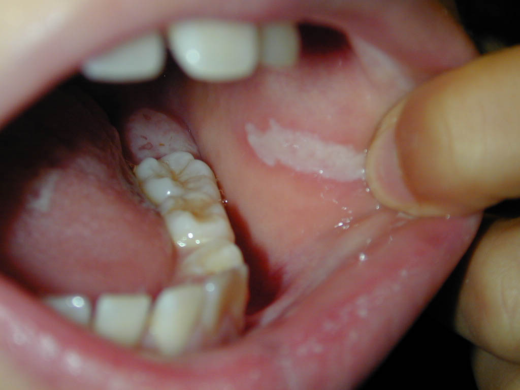 Leukoplakia - Mayo Clinic