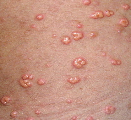 eruptive xanthomatosis