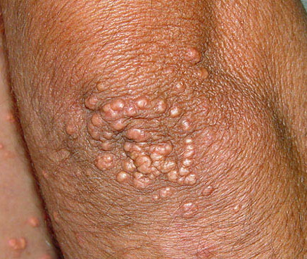 eruptive xanthomatosis #10