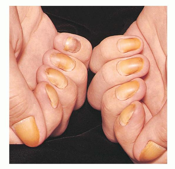 Yellow nail syndrome - huidziekten.nl