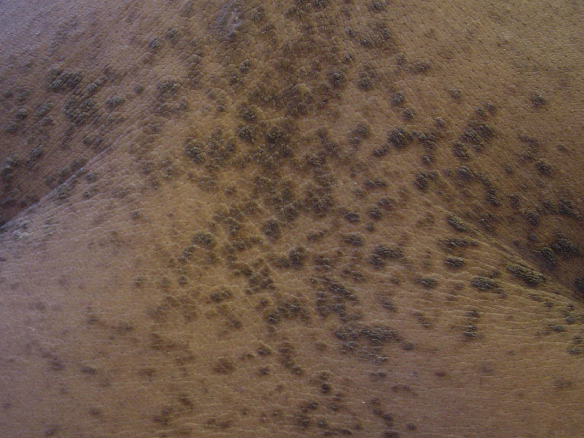 acanthosis nigricans image