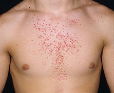 Rash that won't go away with steroids