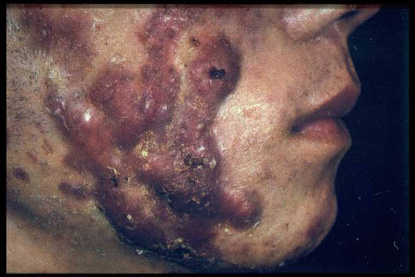 acne_conglobata40.jpg
