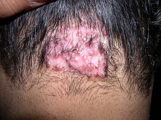 Acne keloidalis en acne keloidalis nuchae - huidziekten.nl