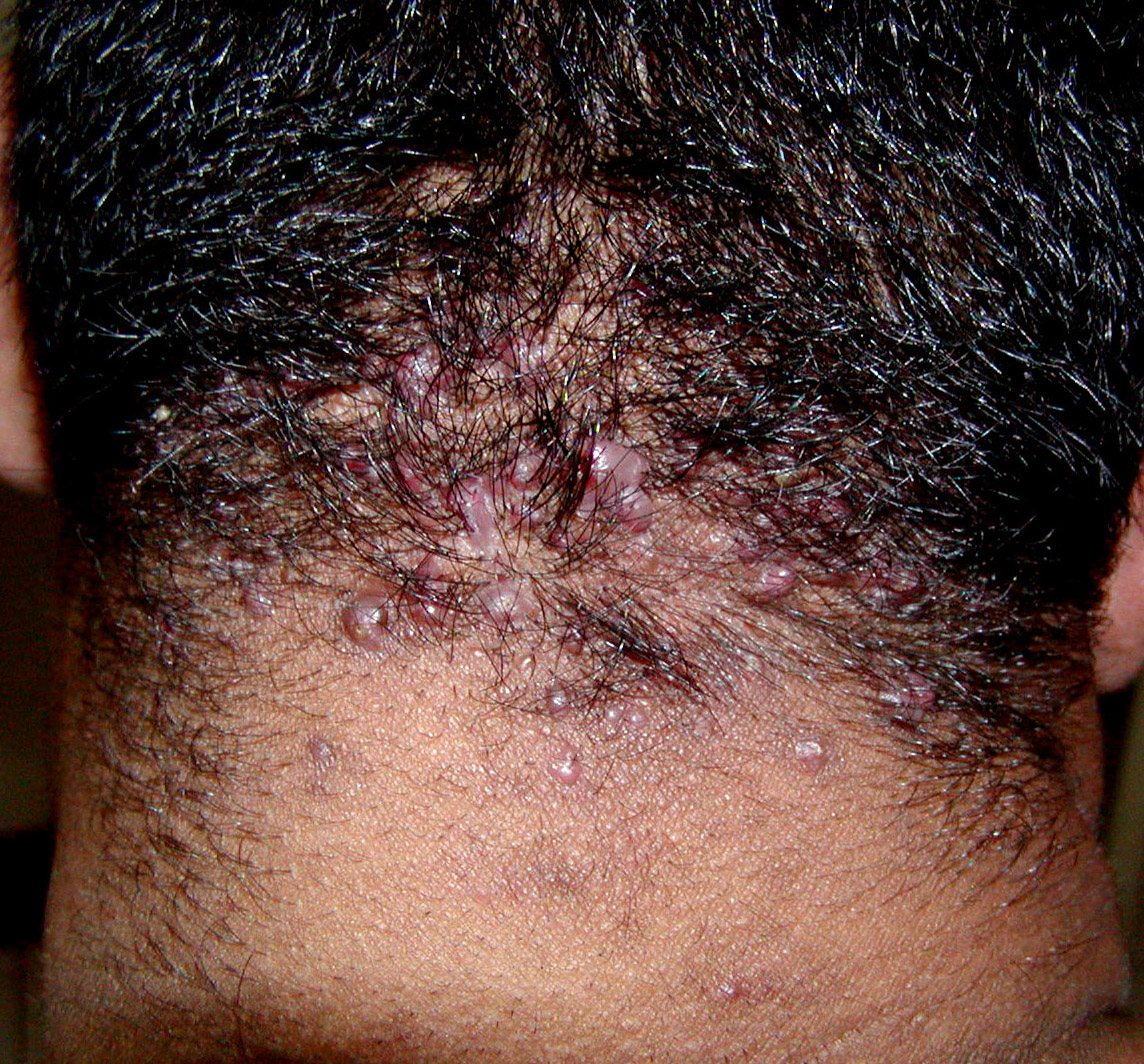 Pseudofolliculitis barbae - Wikipedia