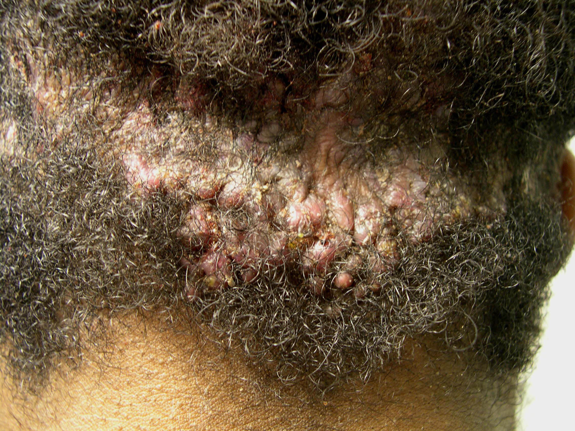 Folliculitis Keloidalis, de behandeling, de symptomen