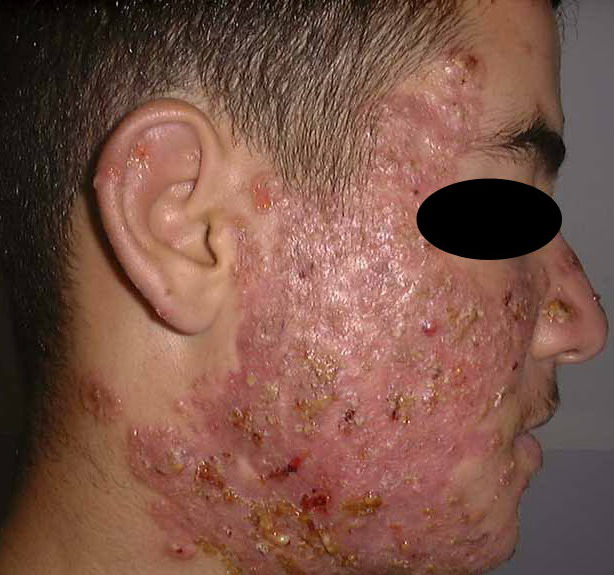 pustular acne