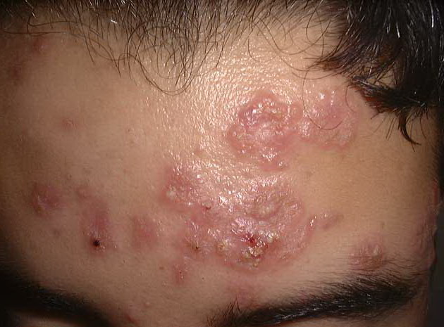 What is Pustular Acne? - Acne