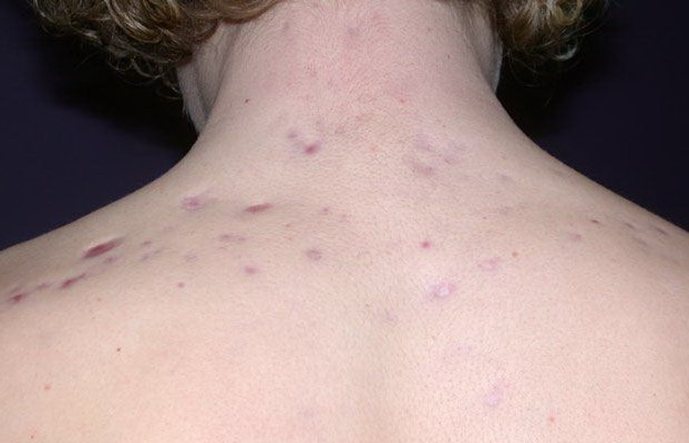 Scarring Acne Treatment