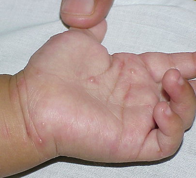 DermIS - Infantile Acropustulosis (information on the ...