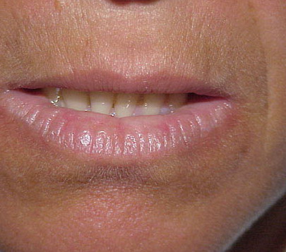 Actinic Cheilitis - Pictures, Treatment, Symptoms, Causes