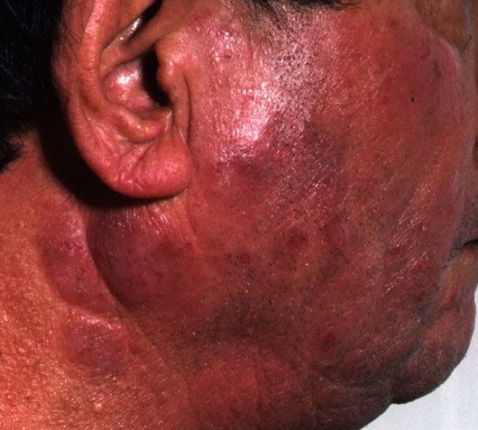 Chronische actinische dermatitis en actinisch reticuloid