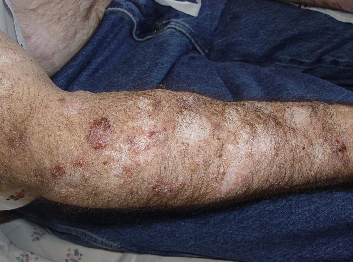 Chronic actinic dermatitis | DermNet New Zealand
