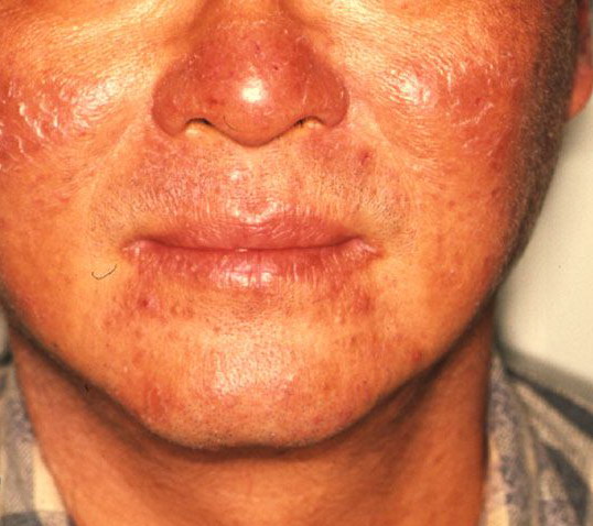 Chronic actinic dermatitis - Wikipedia