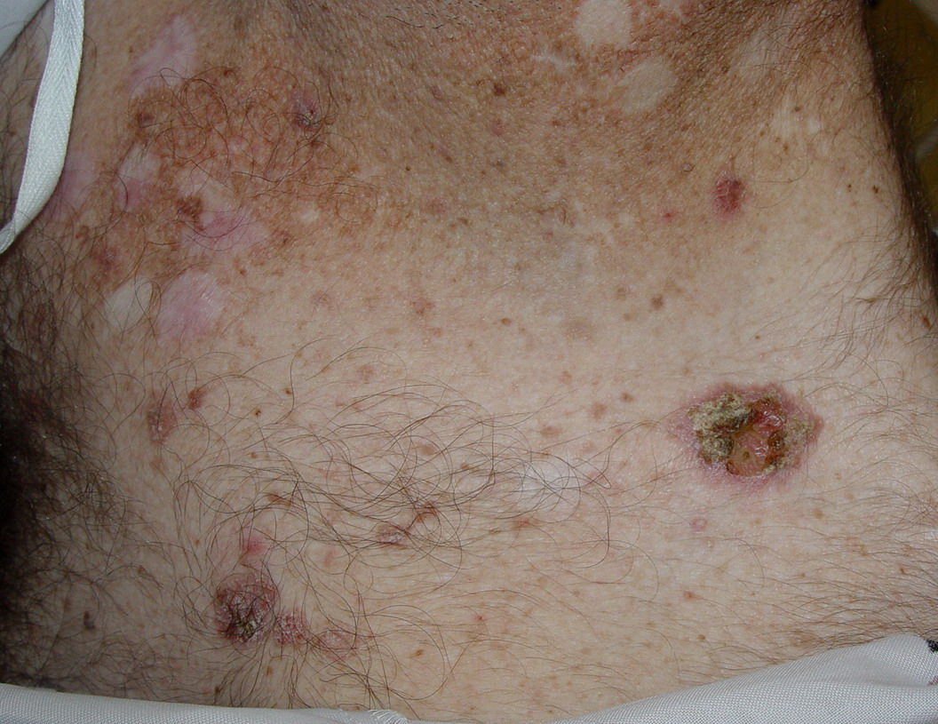 actinic dermatitis