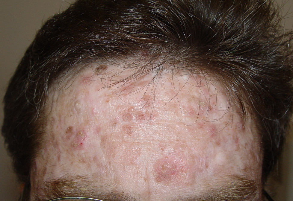 Chronic Actinic Dermatitis: An Analysis Over 25 Years