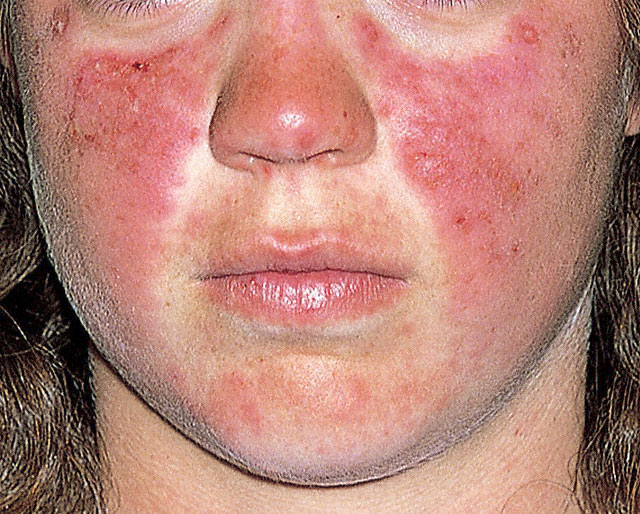 Lupus Symptoms: Cutaneous Lupus