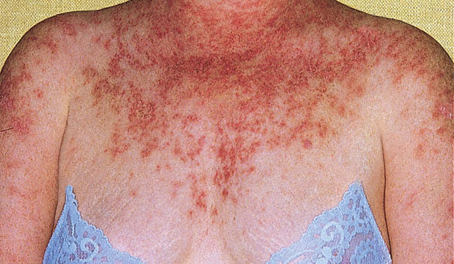 Cutaneous Lupus Erythematosus: Diagnosis and treatment