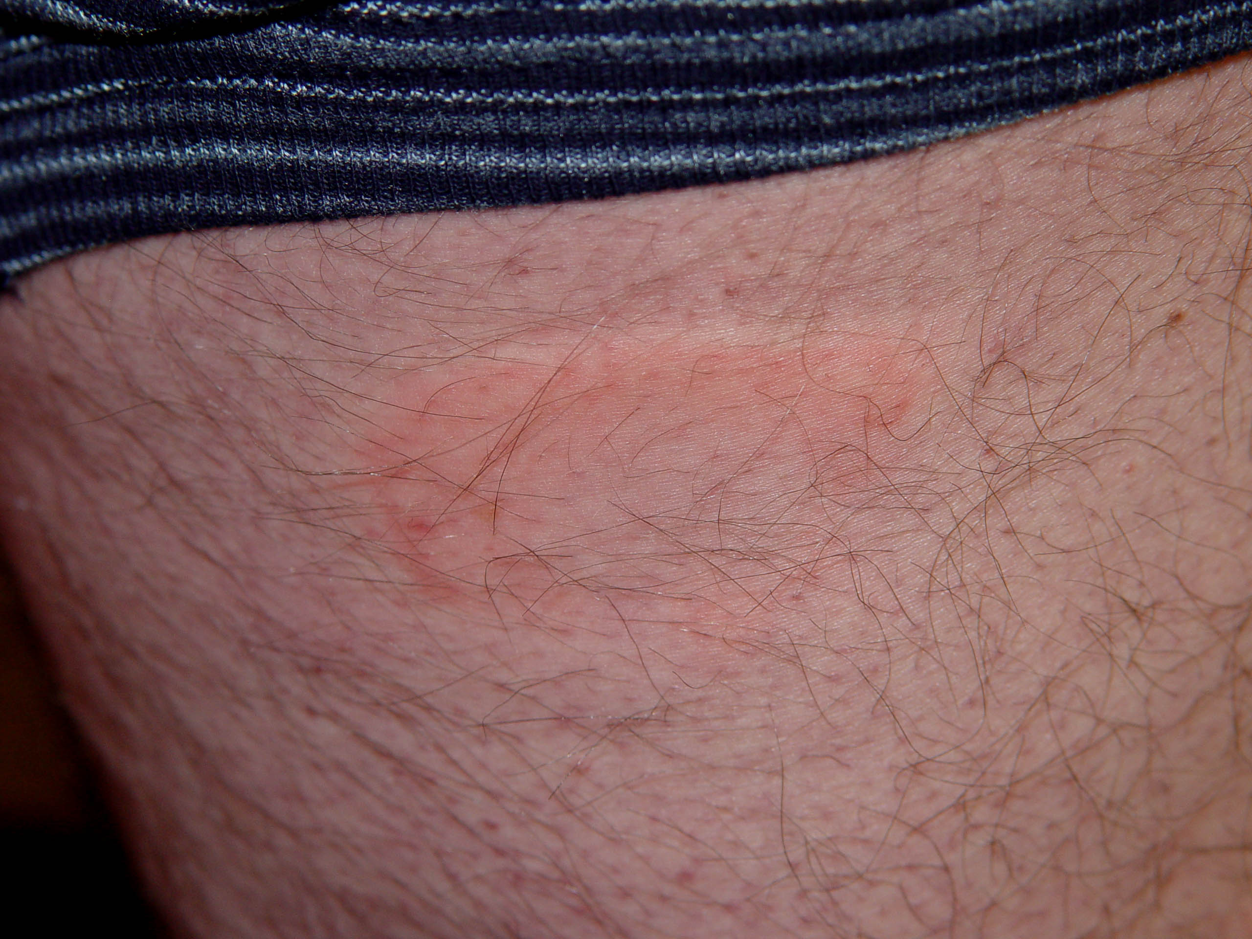 What Are the Causes, Symptoms and Treatment for Hives?