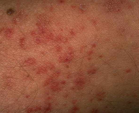 Vasculitis, Allergic Cutaneous; Allergic Cutaneous Angiitis; Allergic Cutaneous Vasculitis ...
