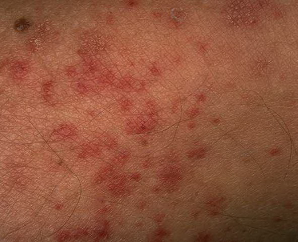 Clinical Approach to Cutaneous Vasculitis - Medscape