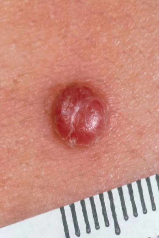 Nodular melanoma - Wikipedia