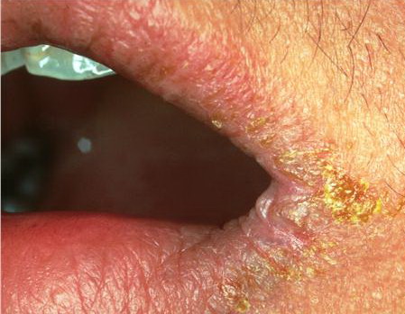 Angular Cheilitis - Symptoms, Causes and Cures
