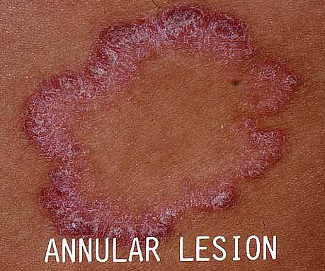 Differentiating Common Annular Lesions: Tinea Corporis vs ...