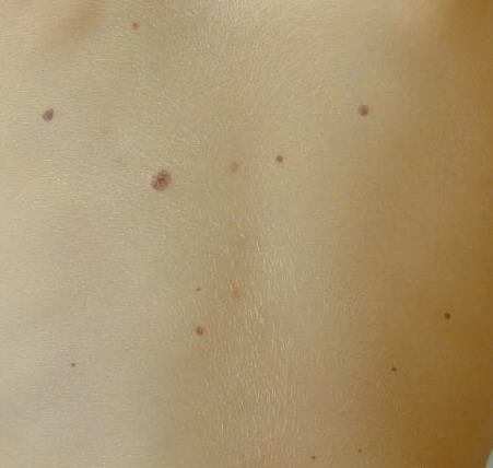 Common Moles, Dysplastic Nevi, and Risk of Melanoma ...