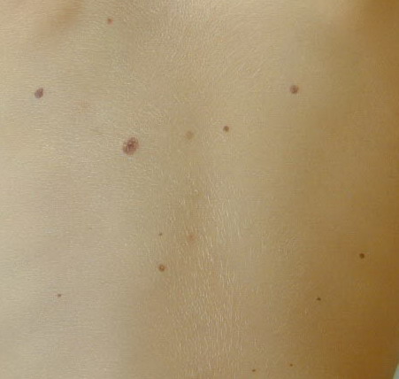 Common Moles, Dysplastic Nevi, and Risk of Melanoma ...