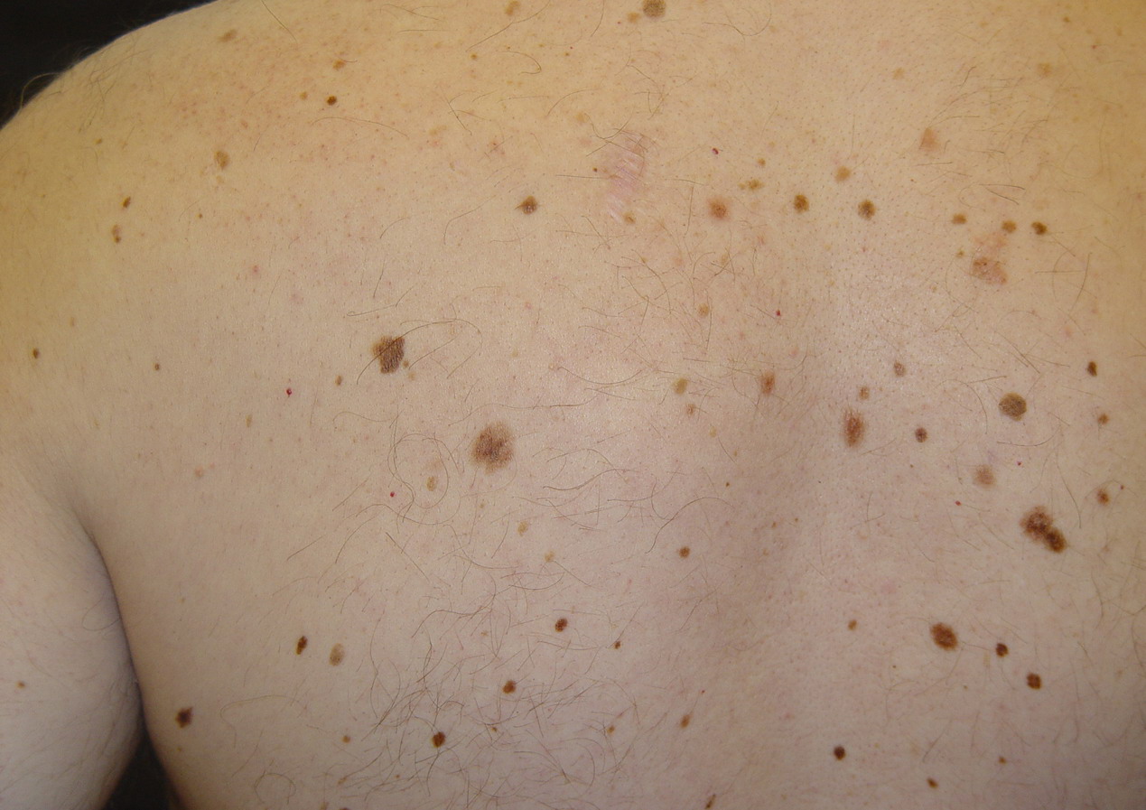 Skin Cancer Symptoms: Pictures of Skin Cancer and ...