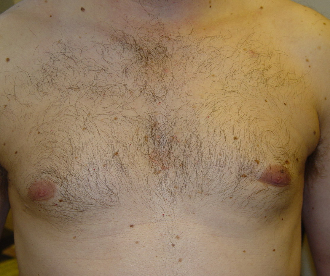 Dysplastic nevus - Wikipedia