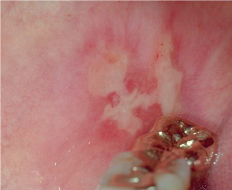 benign mucous membrane pemphigoid #10