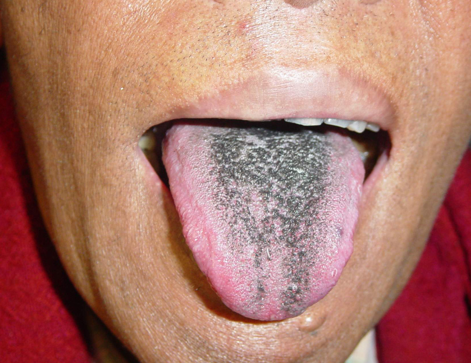 Black Hairy Tongue Pictures, Images & Photos | Photobucket