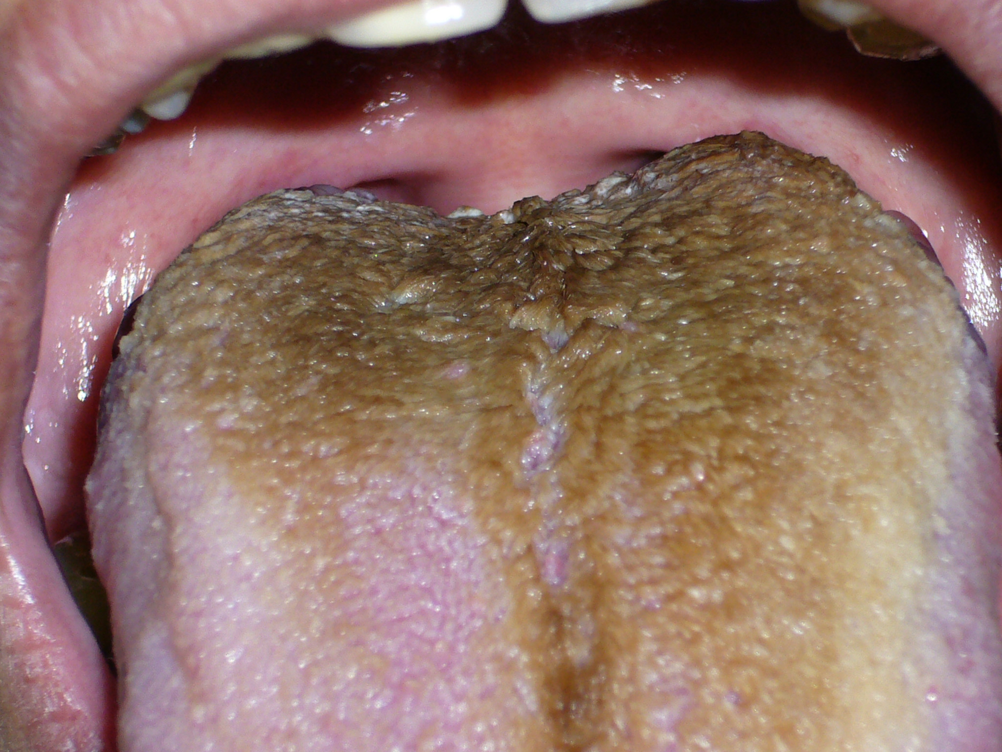hairy tongue disease #11
