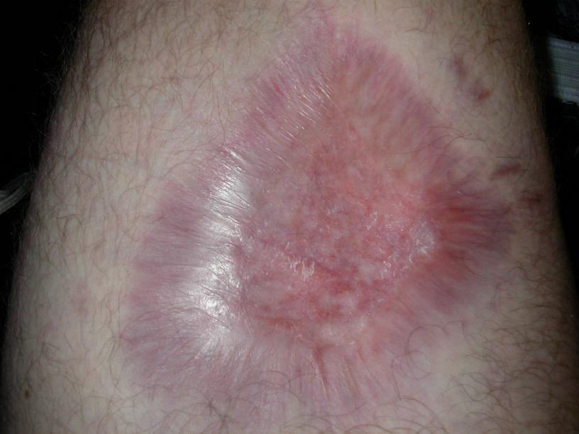 pictures of spider bites on dogs. brown recluse spider bites on